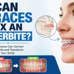 Can Braces Fix an Overbite?